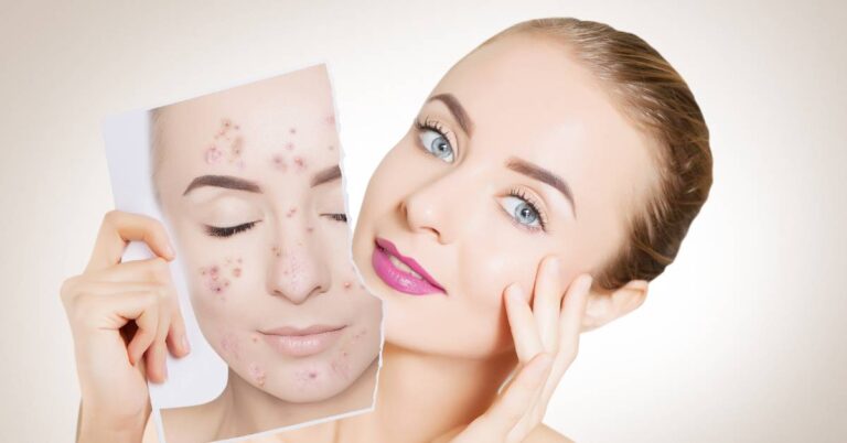 skuteczna walka z tradzikiem – pielegnacja i dieta glowne